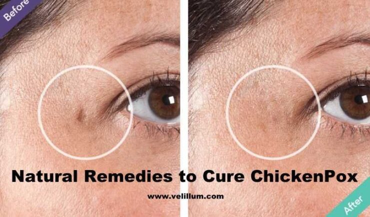 How to cure chickenpox naturally