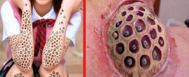 Trypophobia Disease- The Fear of Holes
