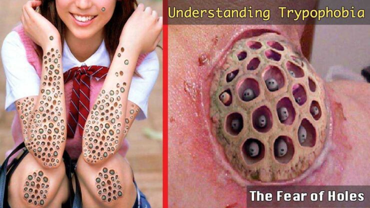Trypophobia Disease- The Fear of Holes