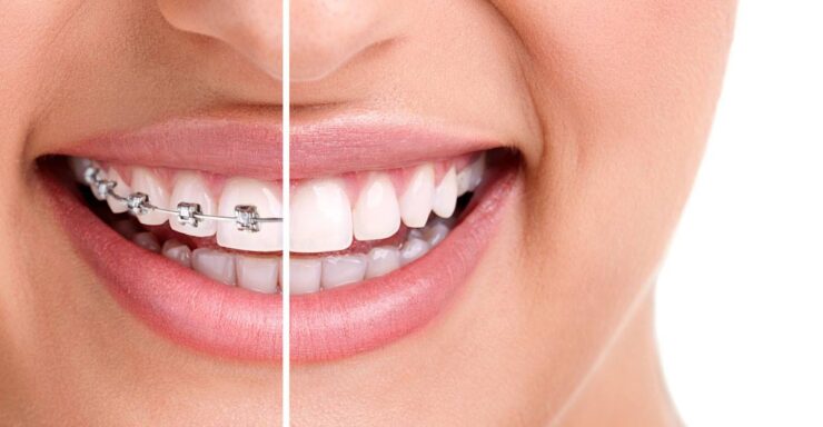 Dental Braces