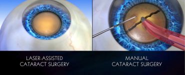 Traditional VS Laser Cataract Surgery