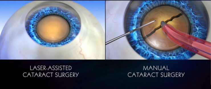 Traditional VS Laser Cataract Surgery