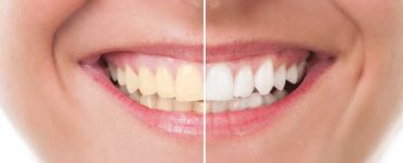 How to keep teeth healthy