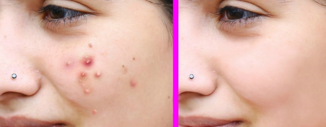Remove Pimples Fast Naturally and Permanently