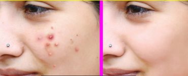 Remove Pimples Fast Naturally and Permanently