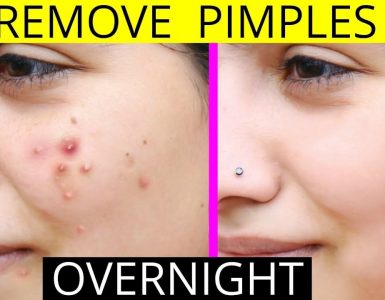 Remove Pimples Fast Naturally and Permanently