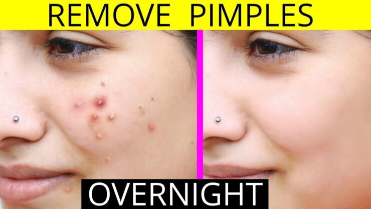 Remove Pimples Fast Naturally and Permanently