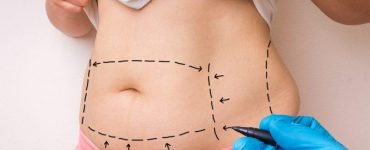 tummy tuck