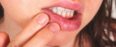 Two Sound ways to treat Cold Sores