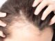 hair loss