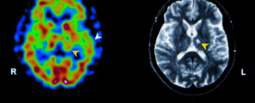Brain SPECT